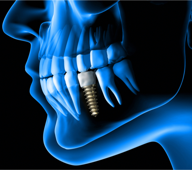 Stoughton The Dental Implant Procedure