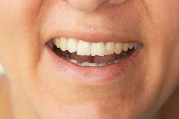 What To Do When You Experience A Broken Tooth