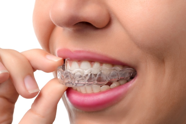 How Do Clear Aligners Straighten Teeth?