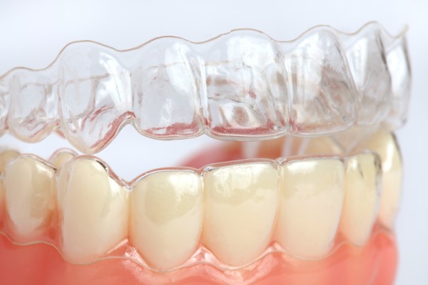 Understanding The Advantages Of Clear Aligners