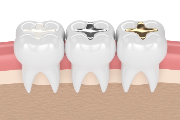 Understanding The Dental Filling Process