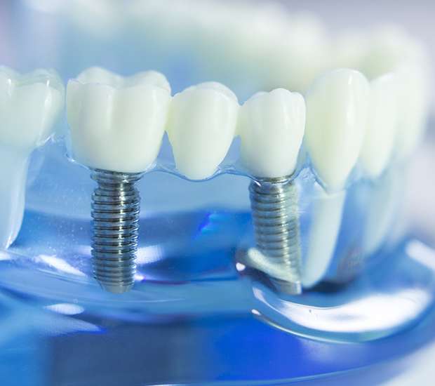 Stoughton Dental Implants