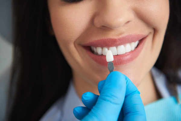 Everything You Need To Know About Dental Veneers